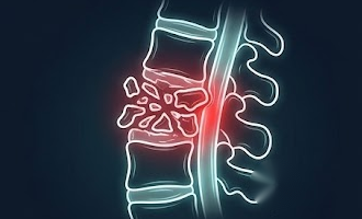 Neon illustration of spinal trauma