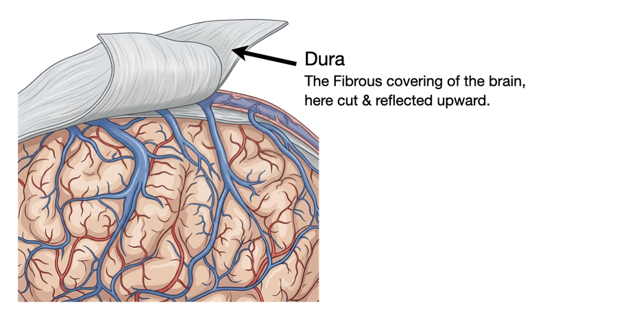 The same diagram with an arrow highlighting one bridging vein as it crosses the subdural space toward the sinus.