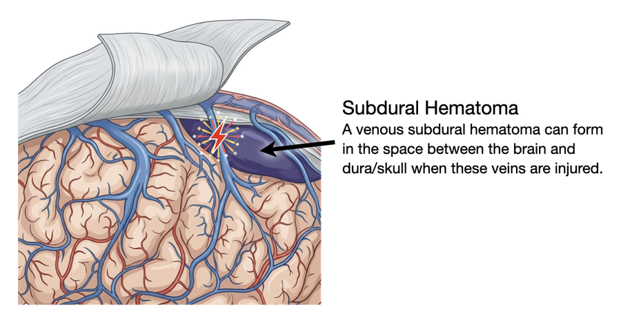 A larger pool of blood in the subdural space, marking the start of a chronic subdural hematoma.