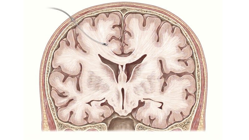 Illustration of an intraparenchymal ICP monitor (bolt) placed a few centimeters into brain tissue